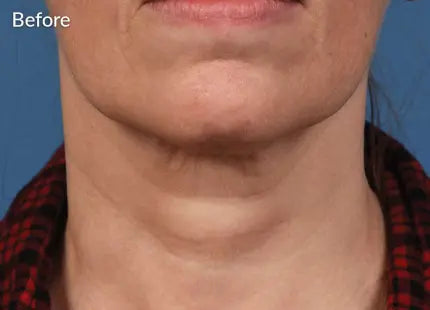 MicroNeedling Skin Pen